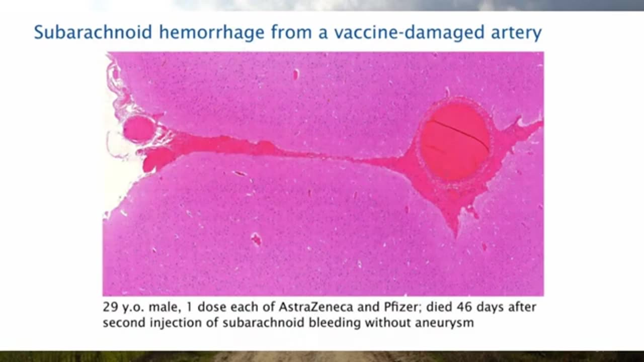 Pathologist Arne Burkhardt Final Interview Revealing the Grave Dangers of mRNA Vaccines