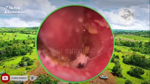 Ear wax removel 4