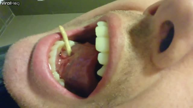 Salivary Stone Squeezed Out of Tongue