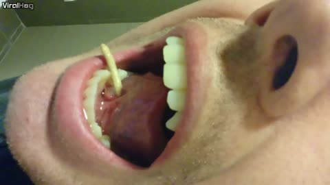 Salivary Stone Squeezed Out of Tongue