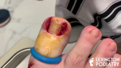 HORRIFYING INGROWN TOENAIL