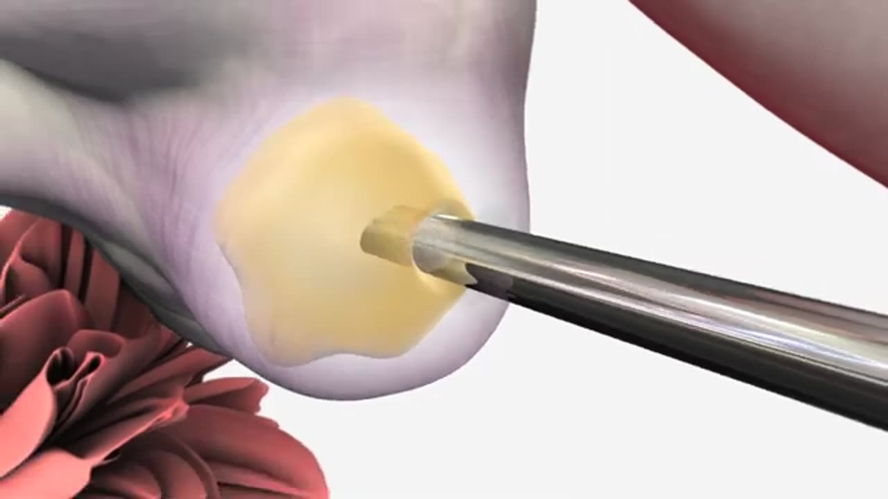 Egg Retrieval - Process of IVF