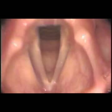 Normal female vocal cords - Stroboscopy