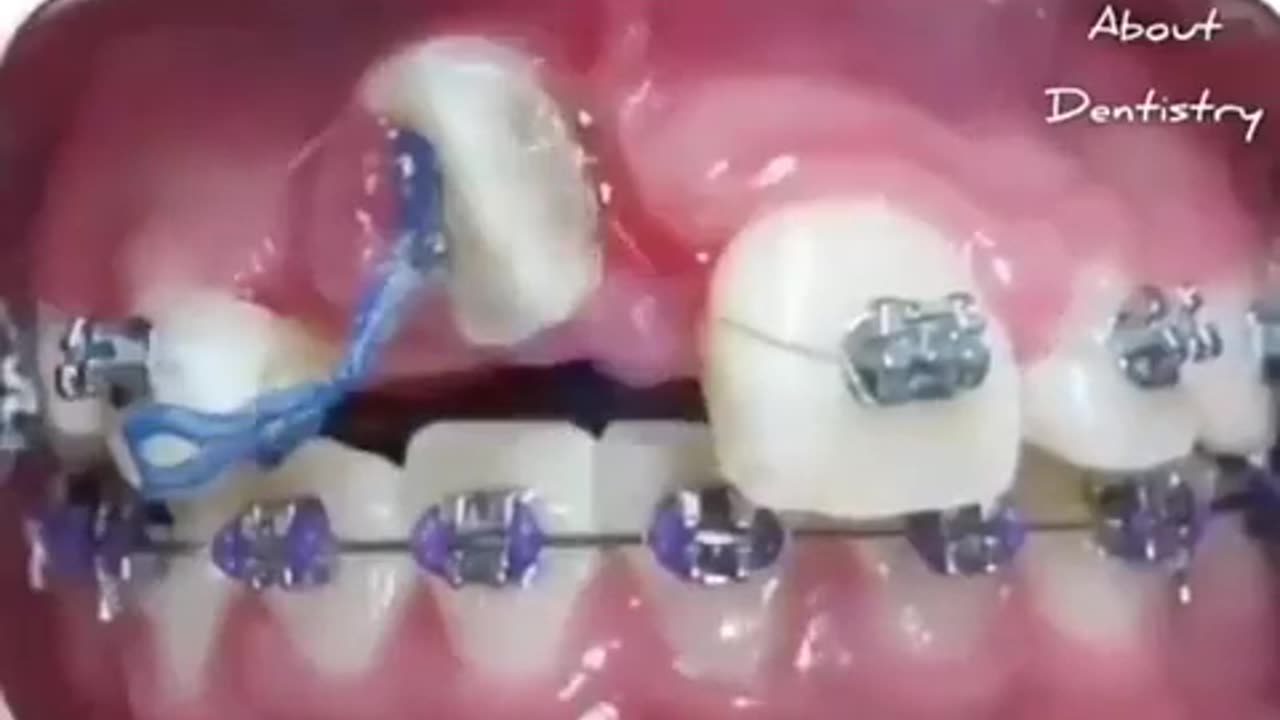 Impressive Orthodontic treatment timelapse