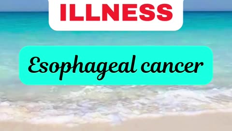 Esophageal cancer: Symptoms and possible remedy.