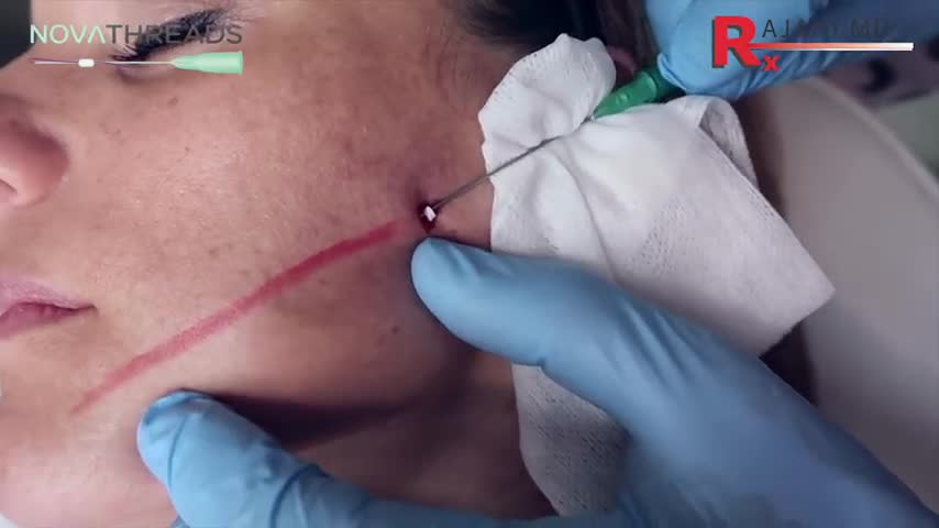 PDO Thread Lift to Tighten Face and Neck