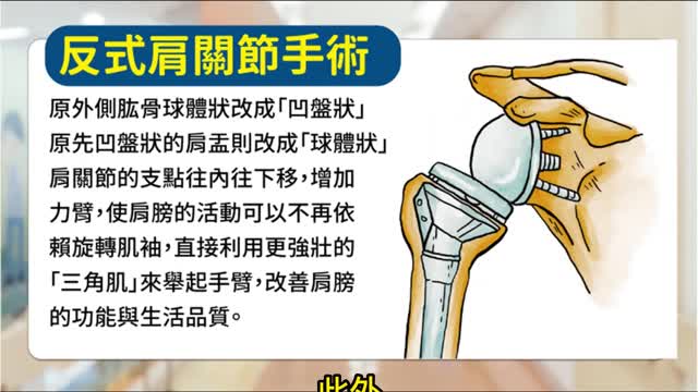 新型反式人工肩關節 置換手術後獲重「伸」