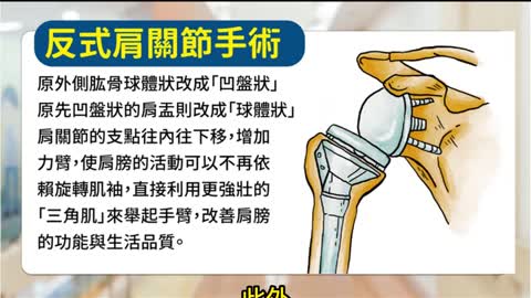 新型反式人工肩關節 置換手術後獲重「伸」