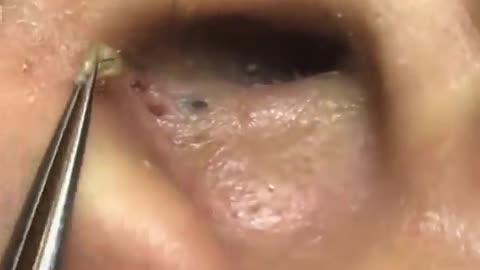 Removal Of Deep Big Blackheads In Ear