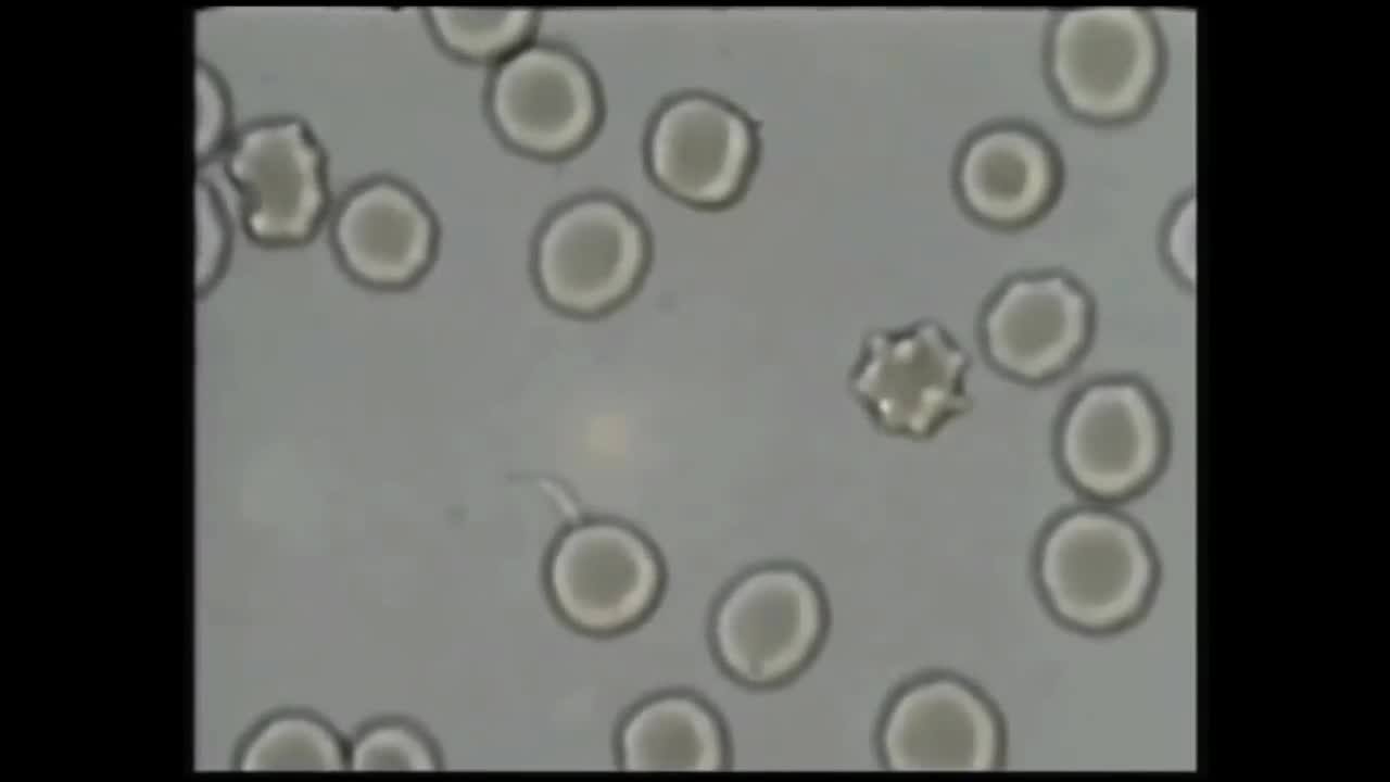 cancer is caused by parasites video