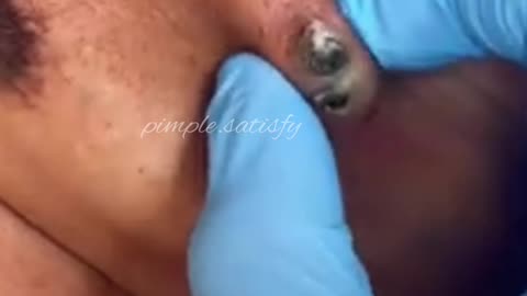 Big blackhead removal ❤️ Amazing 😍