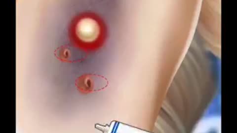 Arms Treatment for side infection