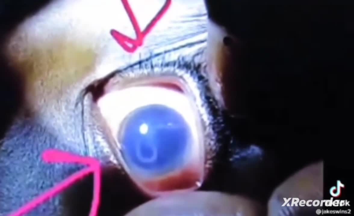 Child's Eyes after death from the jab