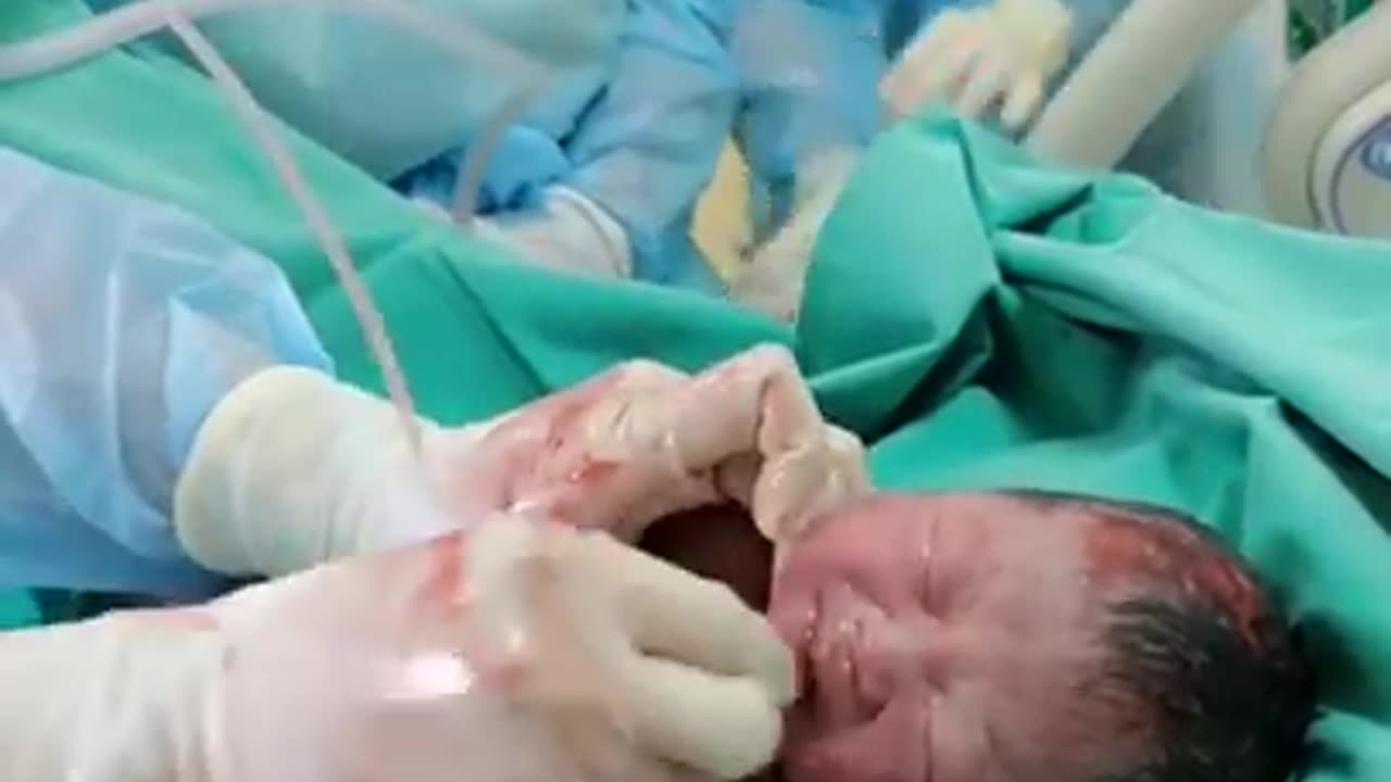 A New Born BABY gets its airway cleared