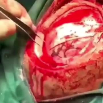 Poor guy getting clots removed after the vax