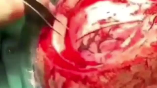 Poor guy getting clots removed after the vax