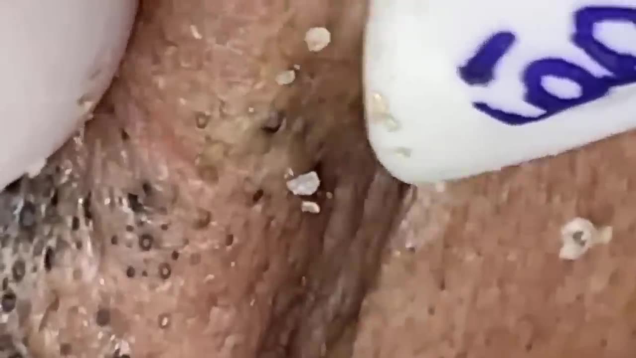 Relaxingggggg with Cleaning Blackheads