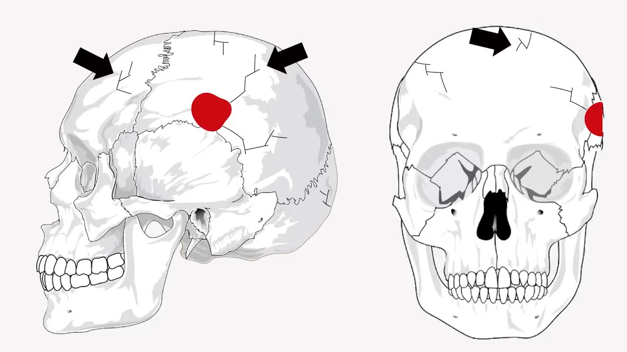 Anatomy of a Headshot