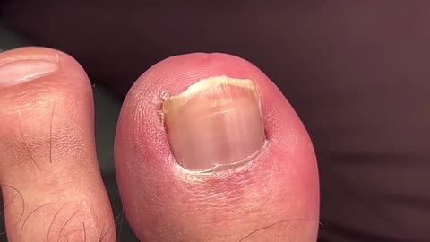 DEEP + BLOODY INGROWN TOENAIL