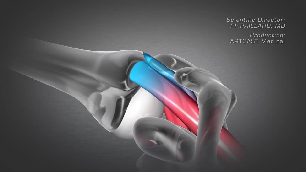 Shoulder Arthroscopy