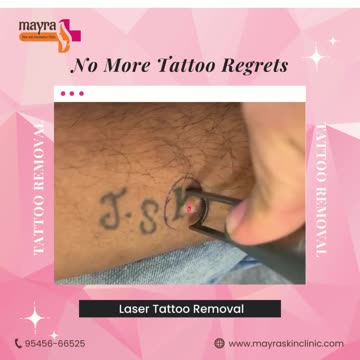 Fade Away: The Power of Laser Tattoo Removal