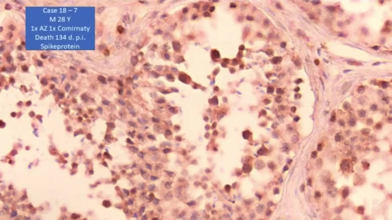 Dr. Arne Burckhardt analysis of spermatozoa in the deceased after vaccination!