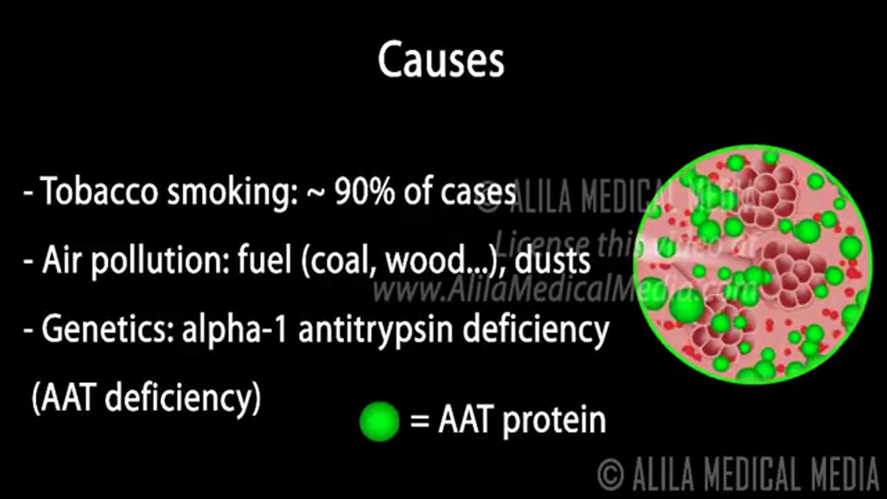 COPD - Chronic Obstructive Pulmonary Disease, Animation.