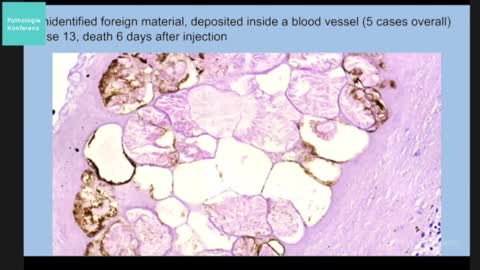 Sudden Adult Death (SADS) Post Jab Autopsies Presented By German Pathologists