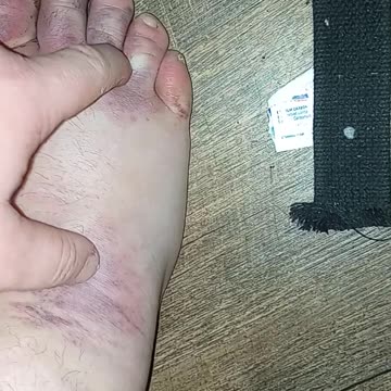 DAY 6 HEALING UPDATE -MY TOES ARE PURPLE TATER TOTS