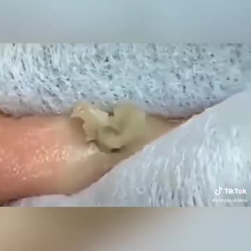 Satisfying Pimple Popping and Ingrowing Hair-