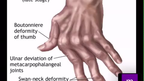 MRCPI Revision of rheumatology 1