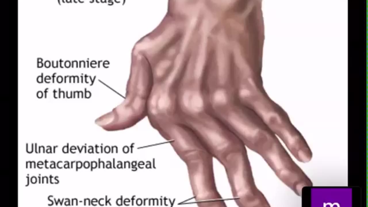 MRCPI Revision of rheumatology 1