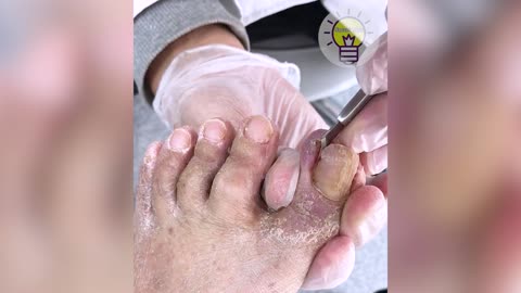How to Clean Toenails - EP2