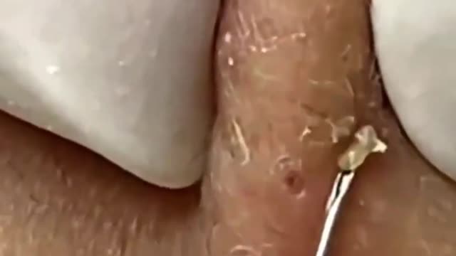 Giants Deep Blackheads, Whiteheads, Big Pimples, Hidden Acne Removal - Best Popping Videos #000004