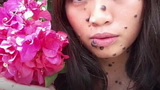 Malaysian girl born with moles covering her body challenges beauty standards