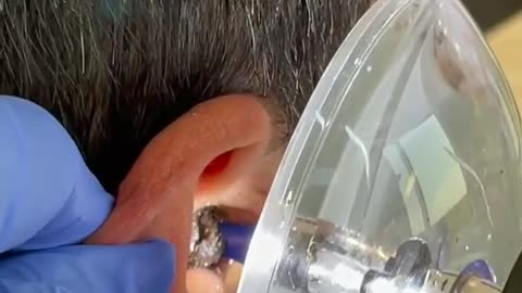 Process ear cleaning