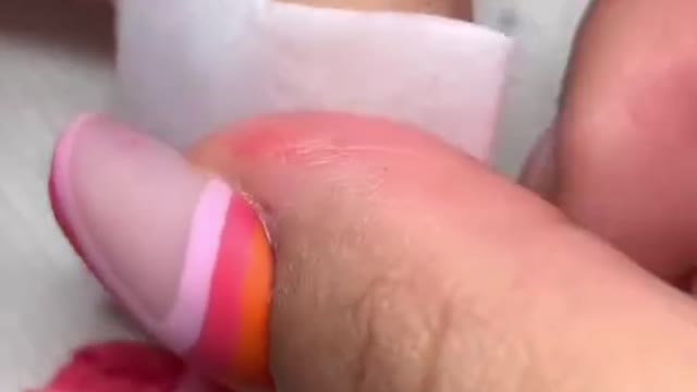Surgery like burberry