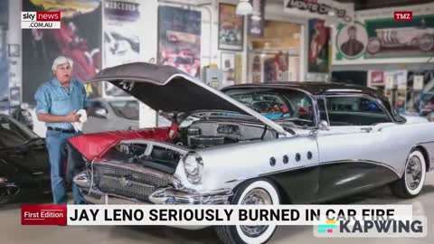 Jay Leno seriously burnt after car fire