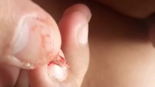 Self-training before you get the jail (Paronychia) 😂😂