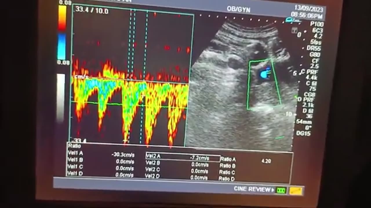 Male Gender of Primigravida With IUGR At 37 Week with No Cord Around Neck 😧😧😧