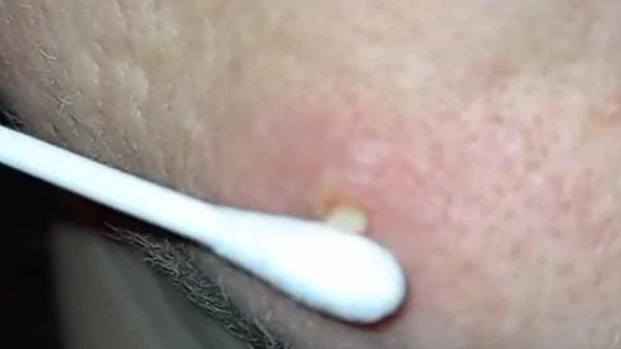 dr pimple popper remove Rounds of Pops - Round