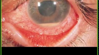 ST5.32 year old lady with painful blurred vision for 3 days