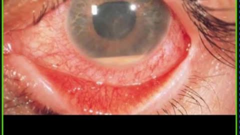 ST5.32 year old lady with painful blurred vision for 3 days