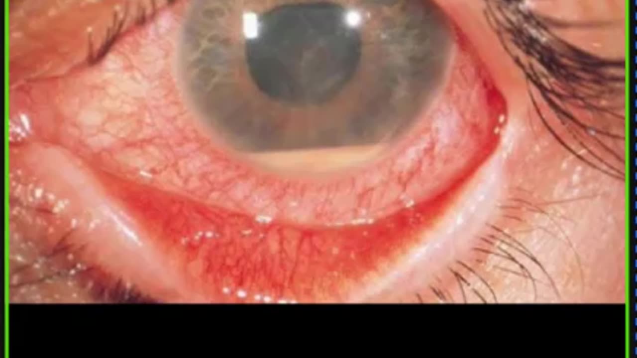 ST5.32 year old lady with painful blurred vision for 3 days