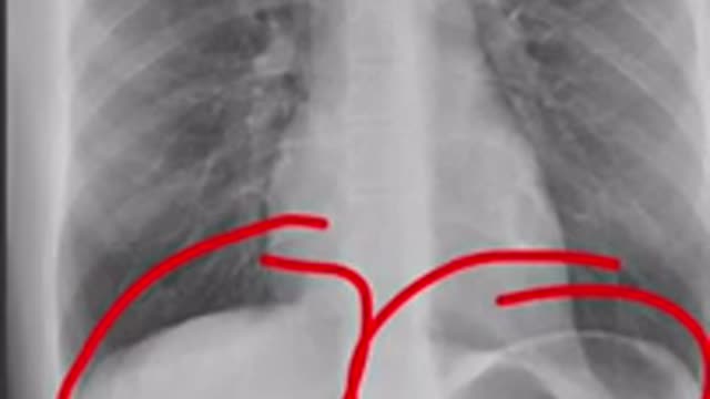 How to read Chest X ray with in one minute