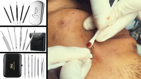 Blackheads Removal & Pimple Popping Videos #02