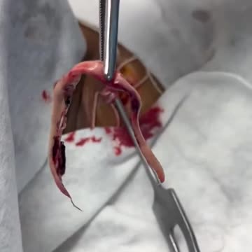 Covid-19 Jab: Hydrogel Clot Removal