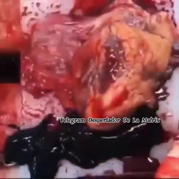 Autopsia de un inoculado capa de oxido de grafeno Vacuna Covid 19