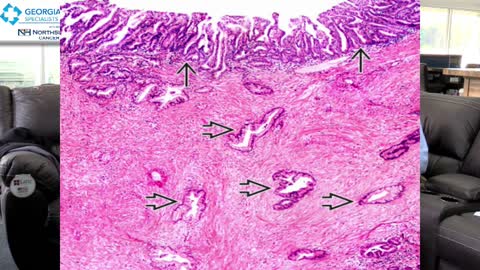 Ask The Doc! Pancreatic Neoplasm & Anorectal Abscesses