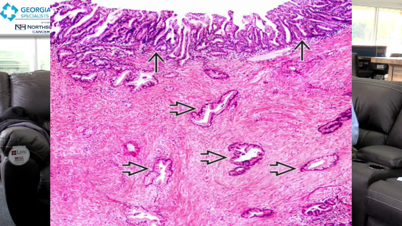 Ask The Doc! Pancreatic Neoplasm & Anorectal Abscesses